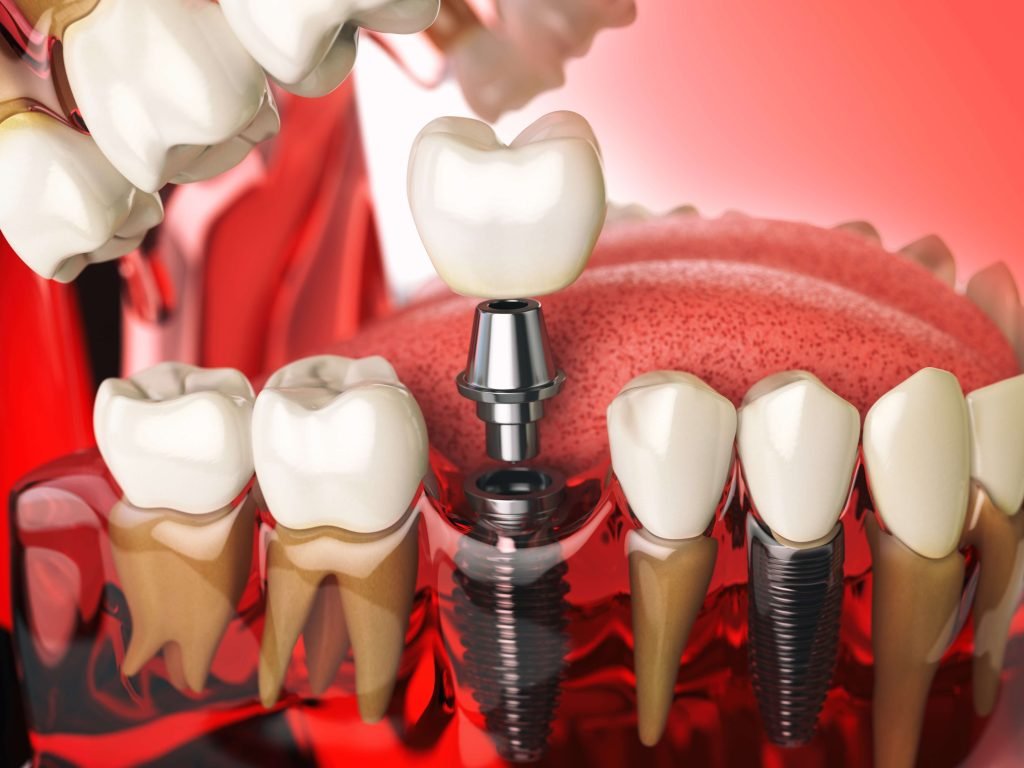 8 signs that you need dental implants